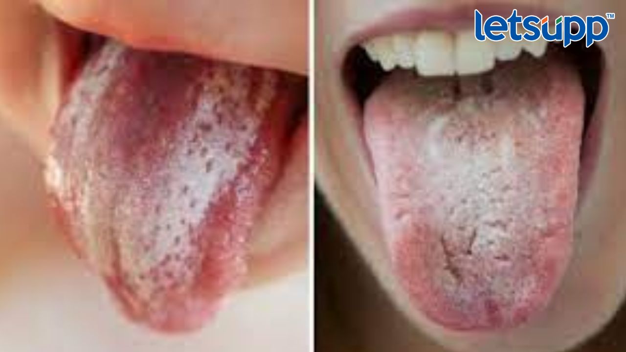 Health Tips : शरीरात या जीवनसत्त्वाची कमतरता असल्यास जीभ पांढरी पडते, या लक्षणांकडे दुर्लक्ष करू नका Untitled Design