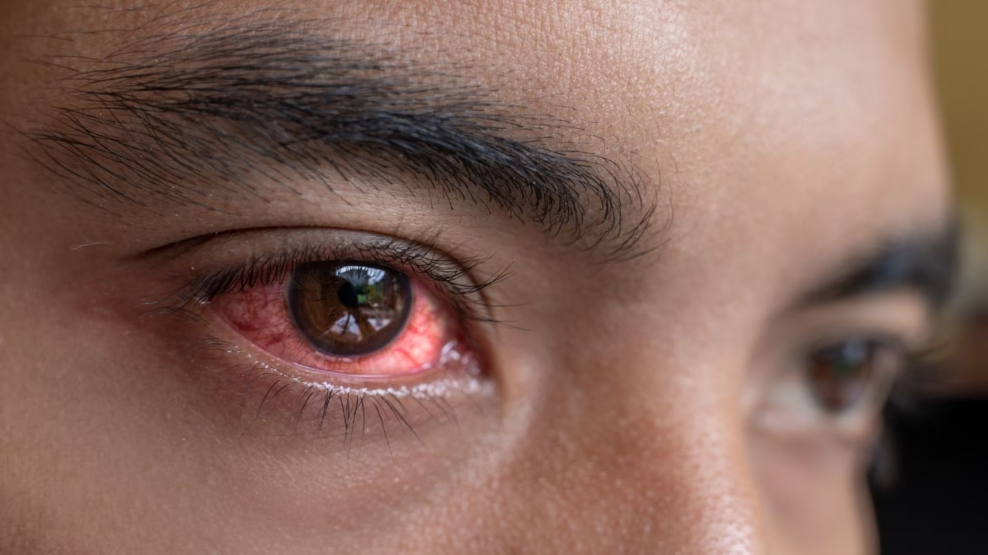 conjunctivitis : महाराष्ट्रात ‘डोळे येणे’ आजाराचा उद्रेक; आळंदी ठरतोय हॉटस्पॉट Eye Flu