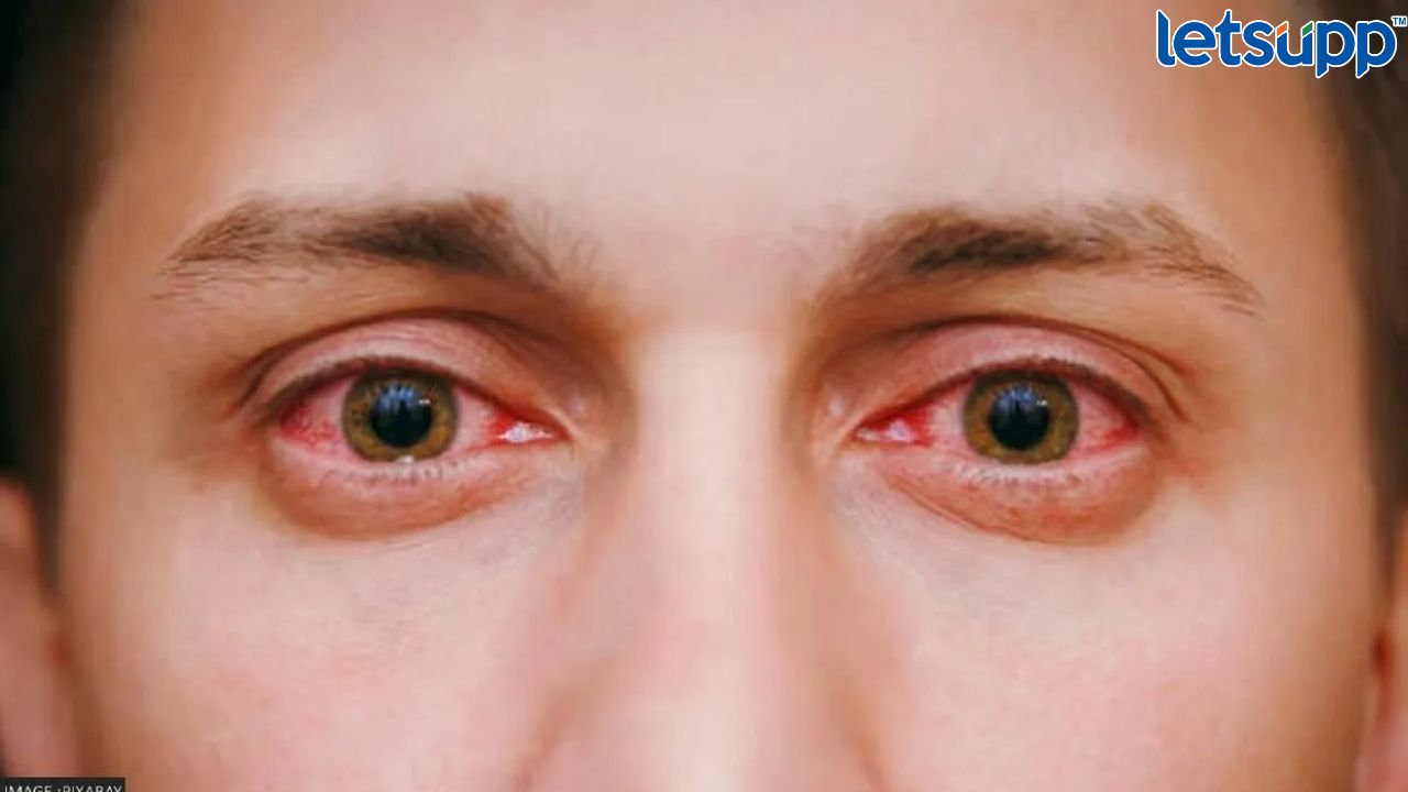 देशात पसरतोय आय फ्लू; तज्ज्ञांनी दिला सल्ला, अशी घ्या काळजी Eye Flue