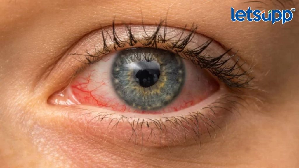 Eye