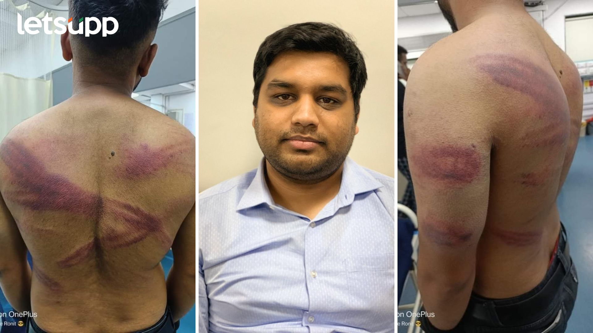 एअरटेलच्या इंजिनिअरला जबर मारहाण : IAS अमन मित्तल अन् भावाविरोधात गुन्हा दाखल, अटकेची मागणी Aman Mittal