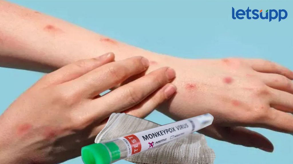 Monkeypox Second Case In India : सावधान, देशात मंकीपॉक्सचा दुसरा रुग्ण, UAE मधून परतलेला व्यक्ती पॉझिटिव्ह