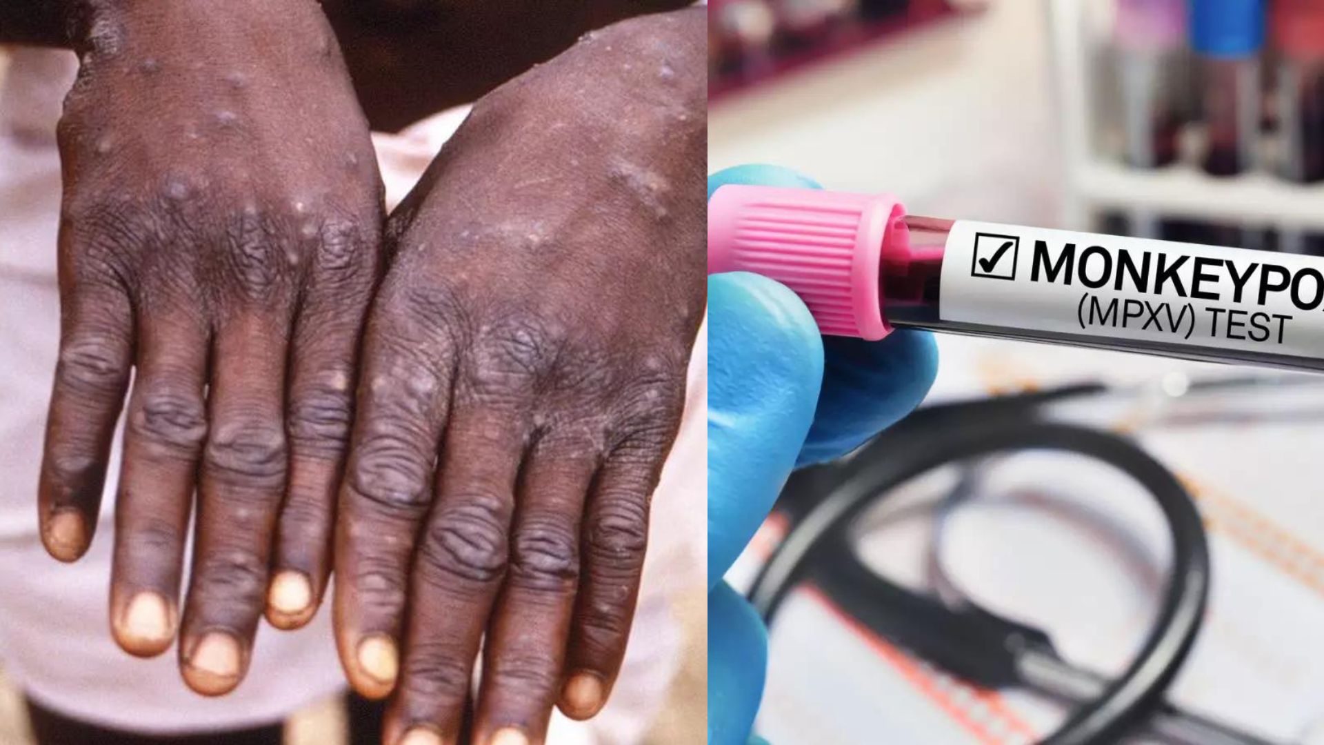 सावधान, देशात मंकीपॉक्सची एन्ट्री? संशयित रुग्णावर उपचार सुरु Monkeypox in India : सावधान, देशात मंकीपॉक्सची एन्ट्री? संशयित रुग्णावर उपचार सुरु