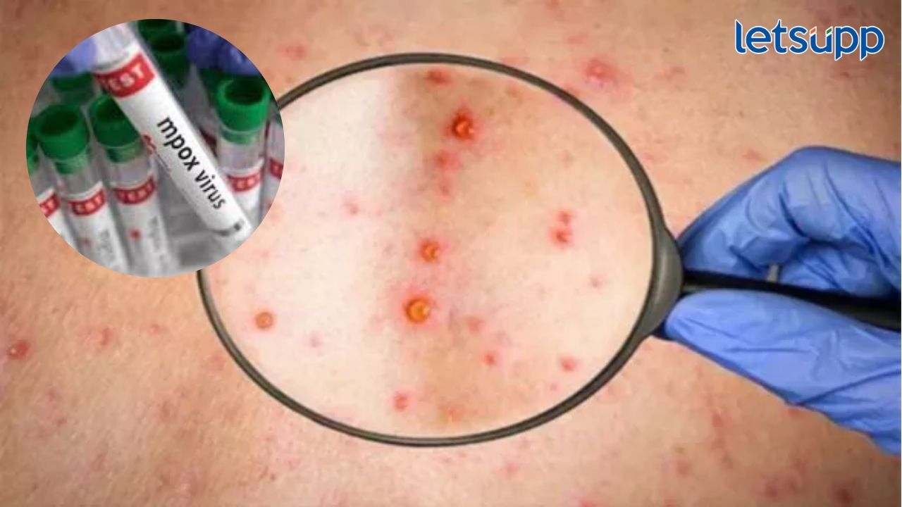 Monkeypox : भारतात मंकीपॉक्सचा पहिला रुग्ण; केंद्र सरकारकडून राज्यांना मार्गदर्शक सूचना Monkeypox