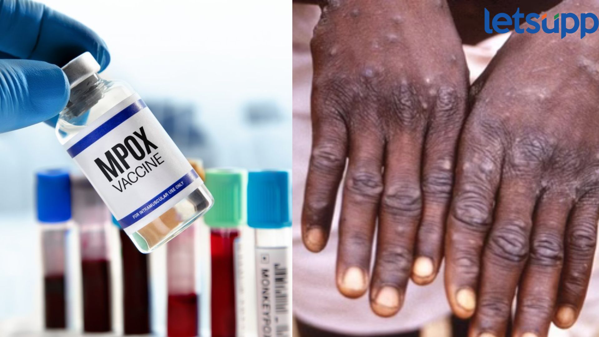 WHO कडून Mpox लसीला मान्यता, लसीकरणाची ‘या’ देशात होणार सुरुवात Mpox Vaccine : WHO कडून Mpox लसीला मान्यता, लसीकरणाची 'या' देशात होणार सुरुवात