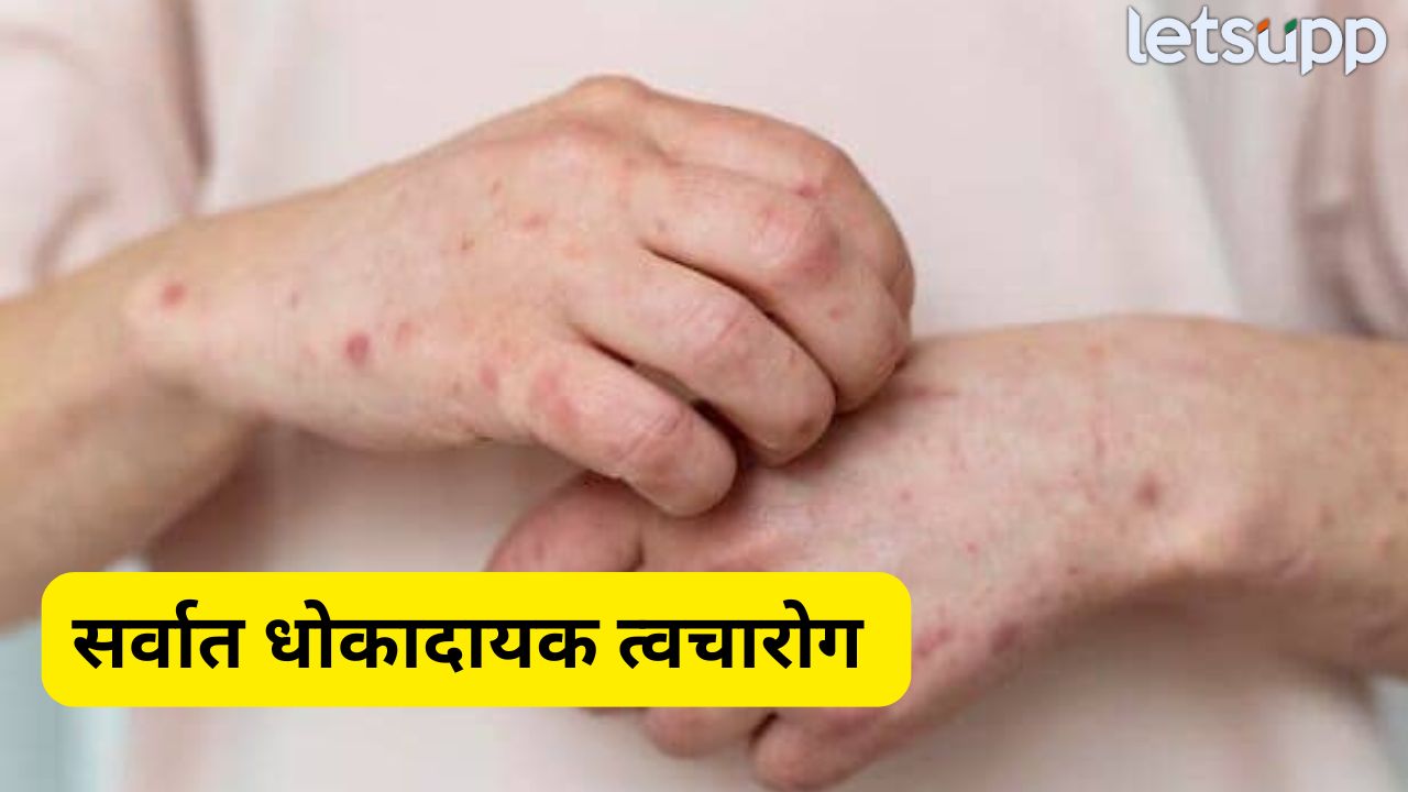 सर्वात धोकादायक त्वचारोग कोणता? त्याची लक्षणे काय…जाणून घ्या एका क्लिकवर SKIN